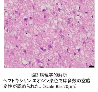 日本长崎大学近日对捐赠给该校医学部用于解剖实习的遗体进行检查时，在其中一具遗体的大脑新皮质中检测出了朊毒体蛋白质